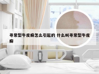 寻常型牛皮癣怎么引起的 什么叫寻常型牛皮癣