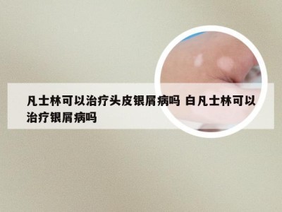 凡士林可以治疗头皮银屑病吗 白凡士林可以治疗银屑病吗