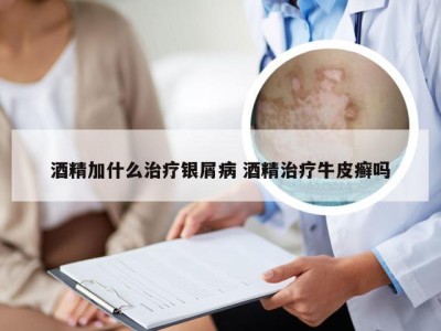 酒精加什么治疗银屑病 酒精治疗牛皮癣吗