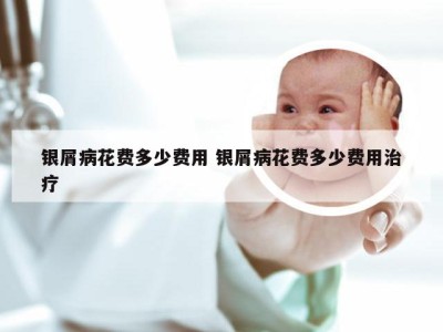 银屑病花费多少费用 银屑病花费多少费用治疗