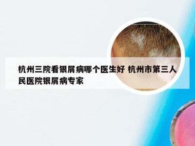 杭州三院看银屑病哪个医生好 杭州市第三人民医院银屑病专家