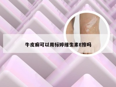 牛皮癣可以用标婷维生素E擦吗