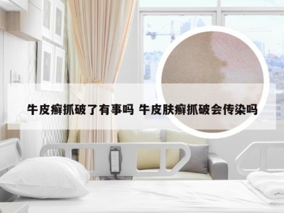 牛皮癣抓破了有事吗 牛皮肤癣抓破会传染吗