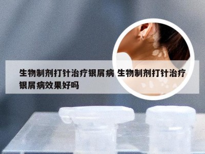 生物制剂打针治疗银屑病 生物制剂打针治疗银屑病效果好吗