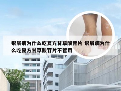 银屑病为什么吃复方甘草酸苷片 银屑病为什么吃复方甘草酸苷片不管用