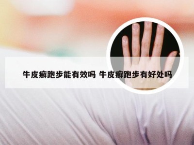 牛皮癣跑步能有效吗 牛皮癣跑步有好处吗