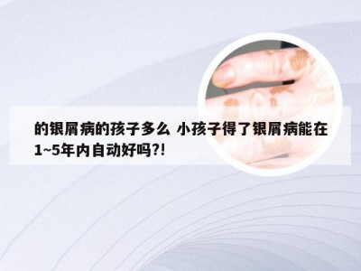 的银屑病的孩子多么 小孩子得了银屑病能在1~5年内自动好吗?!