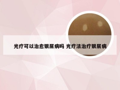 光疗可以治愈银屑病吗 光疗法治疗银屑病