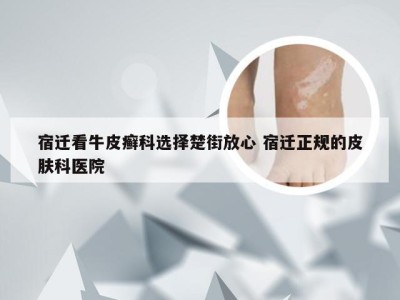 宿迁看牛皮癣科选择楚街放心 宿迁正规的皮肤科医院
