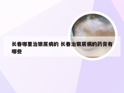 长春哪里治银屑病的 长春治银屑病的药膏有哪些