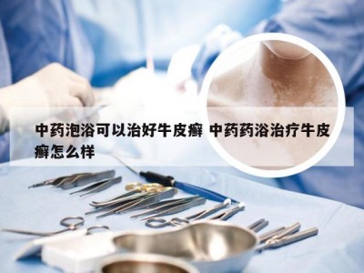 中药泡浴可以治好牛皮癣 中药药浴治疗牛皮癣怎么样