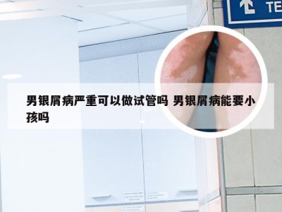 男银屑病严重可以做试管吗 男银屑病能要小孩吗