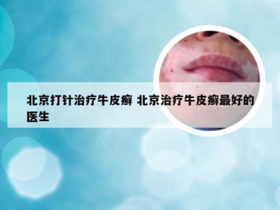 北京打针治疗牛皮癣 北京治疗牛皮癣最好的医生