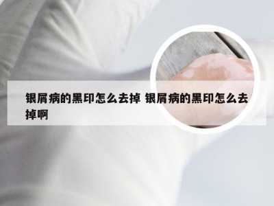 银屑病的黑印怎么去掉 银屑病的黑印怎么去掉啊