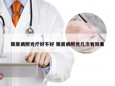 银屑病照光疗好不好 银屑病照光几次有效果