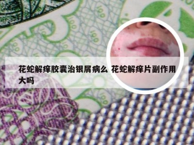 花蛇解痒胶囊治银屑病么 花蛇解痒片副作用大吗
