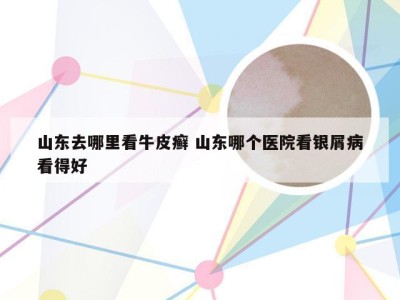 山东去哪里看牛皮癣 山东哪个医院看银屑病看得好