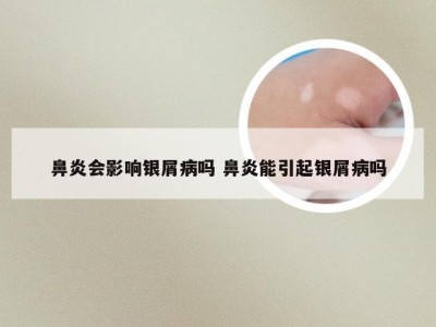 鼻炎会影响银屑病吗 鼻炎能引起银屑病吗