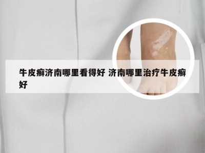 牛皮癣济南哪里看得好 济南哪里治疗牛皮癣好