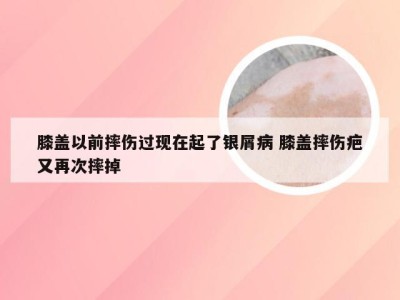 膝盖以前摔伤过现在起了银屑病 膝盖摔伤疤又再次摔掉