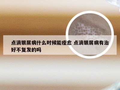 点滴银屑病什么时候能痊愈 点滴银屑病有治好不复发的吗