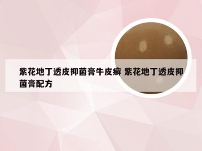 紫花地丁透皮抑菌膏牛皮癣 紫花地丁透皮抑菌膏配方