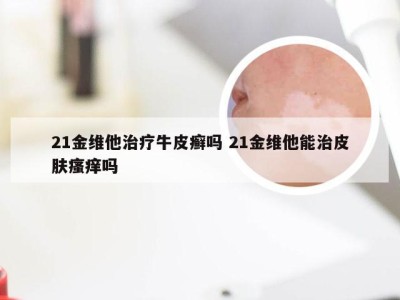 21金维他治疗牛皮癣吗 21金维他能治皮肤瘙痒吗