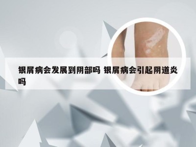银屑病会发展到阴部吗 银屑病会引起阴道炎吗