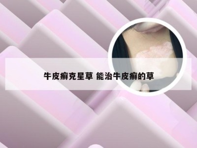 牛皮癣克星草 能治牛皮癣的草