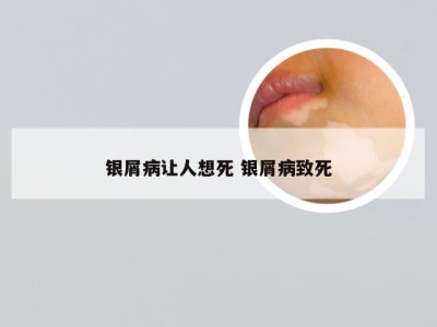 银屑病让人想死 银屑病致死