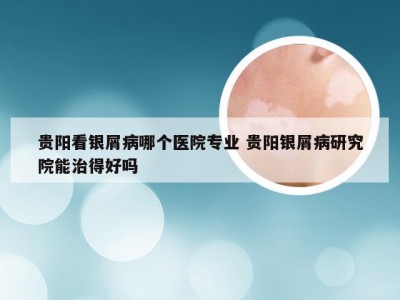 贵阳看银屑病哪个医院专业 贵阳银屑病研究院能治得好吗