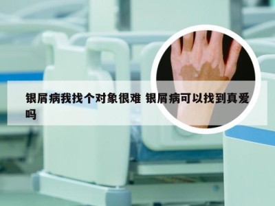 银屑病我找个对象很难 银屑病可以找到真爱吗