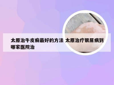 太原治牛皮癣最好的方法 太原治疗银屑病到哪家医院治