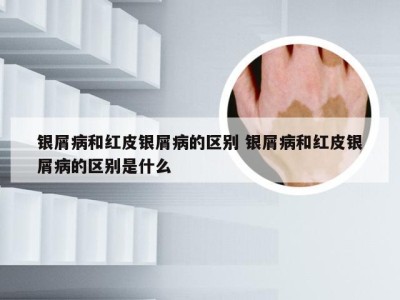 银屑病和红皮银屑病的区别 银屑病和红皮银屑病的区别是什么