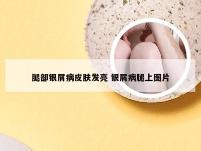 腿部银屑病皮肤发亮 银屑病腿上图片