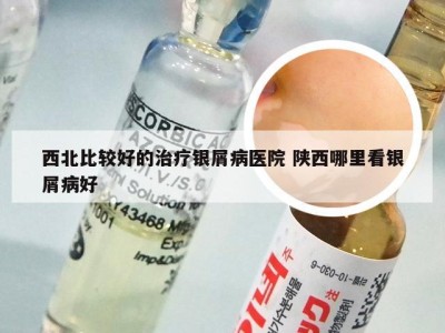 西北比较好的治疗银屑病医院 陕西哪里看银屑病好