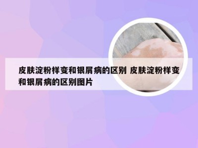 皮肤淀粉样变和银屑病的区别 皮肤淀粉样变和银屑病的区别图片