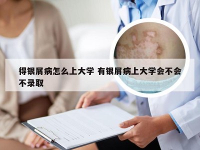 得银屑病怎么上大学 有银屑病上大学会不会不录取