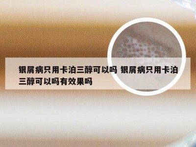 银屑病只用卡泊三醇可以吗 银屑病只用卡泊三醇可以吗有效果吗