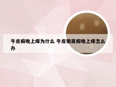 牛皮癣晚上痒为什么 牛皮银屑癣晚上痒怎么办