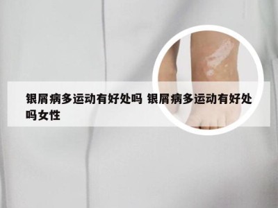 银屑病多运动有好处吗 银屑病多运动有好处吗女性