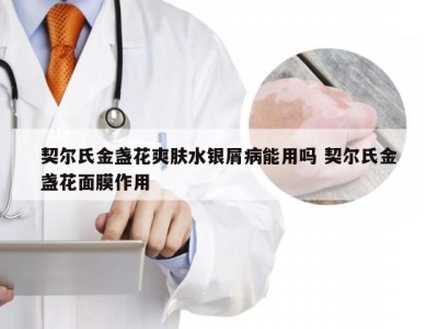 契尔氏金盏花爽肤水银屑病能用吗 契尔氏金盏花面膜作用