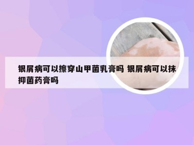 银屑病可以擦穿山甲菌乳膏吗 银屑病可以抹抑菌药膏吗