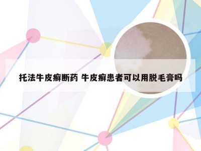 托法牛皮癣断药 牛皮癣患者可以用脱毛膏吗