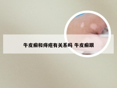 牛皮癣和痔疮有关系吗 牛皮癣跟