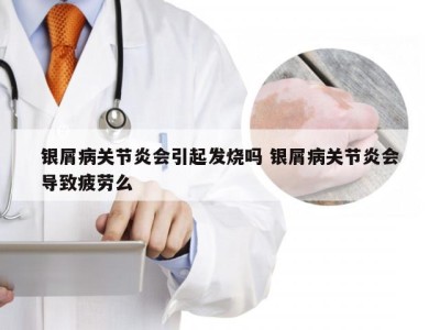 银屑病关节炎会引起发烧吗 银屑病关节炎会导致疲劳么