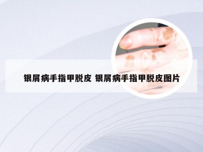 银屑病手指甲脱皮 银屑病手指甲脱皮图片