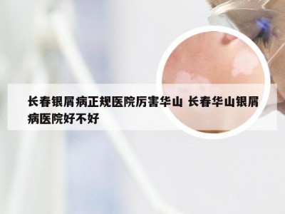 长春银屑病正规医院厉害华山 长春华山银屑病医院好不好