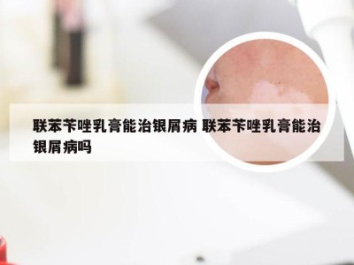 联苯苄唑乳膏能治银屑病 联苯苄唑乳膏能治银屑病吗