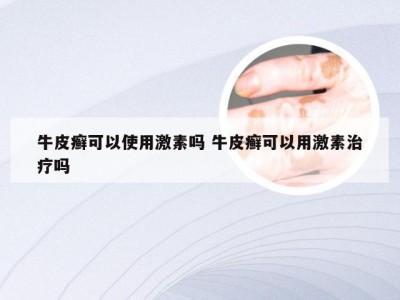 牛皮癣可以使用激素吗 牛皮癣可以用激素治疗吗